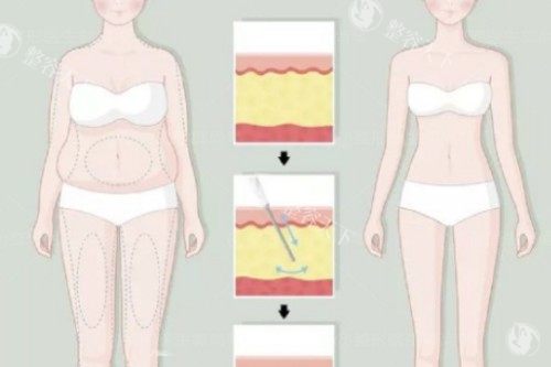 吸脂卡通前后对比一览图