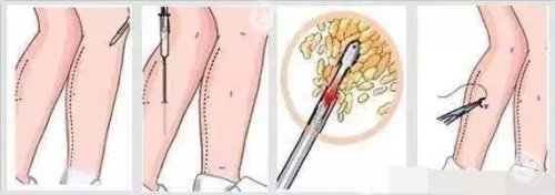 腿部吸脂示意图