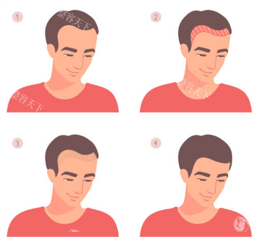 发际线植发前后图解