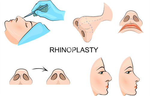 沈阳黄瑞兴医生鼻子做得怎么样，鼻型设计贴合面部/手法细腻塑形自然/鼻梁立体口碑佳！