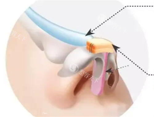 隆鼻假体植入鼻背动画展示图