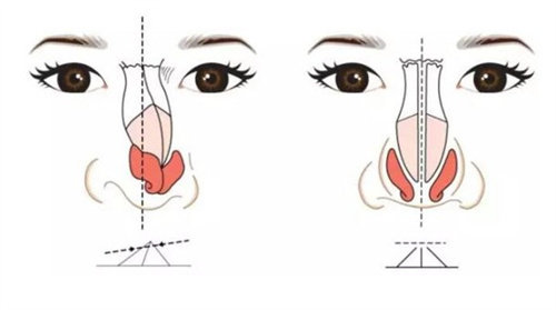 福州出名的鼻整形医生：郑少雄、温名赟、朱刚强、马美洲、许喜雄、练银发六位医生出名技术娴熟~