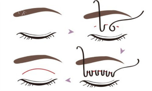 三次修复失败后上岸：史迎军技术让我的“多层褶”重获新生