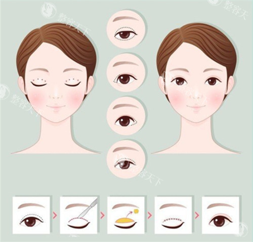 切开双眼皮手术前后对比和过程
