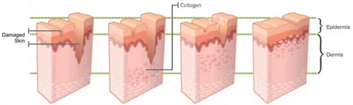 收藏！北京凹陷疤痕修复价格表全公开：黄金微针2000+关节挛缩疤痕2500+PRP联合激光4000+