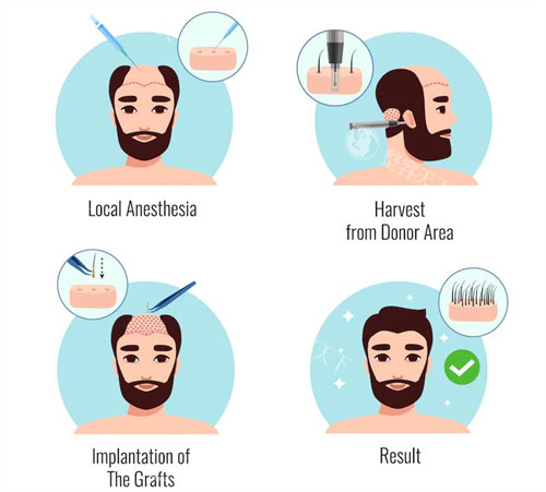 成都华西医院植发多少钱？2026新报价：毛囊10-25元起/单位，不同脱发程度对应价格区间清晰梳理