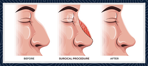 失败鼻子的前后对比图