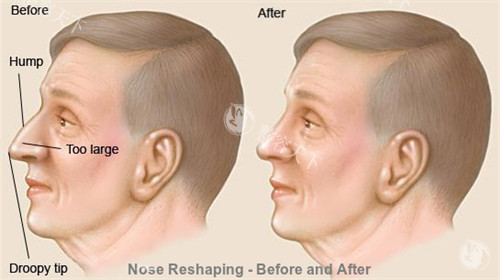 正常鼻子和过长的鼻子矫正对比