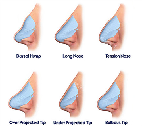郑州胡志成医生做的鼻子真的自然吗？专攻自然款鼻，CT定制+软骨支架重建鼻型贴合面部比例！
