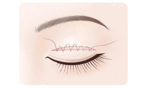 于晓雪双眼皮要避雷吗？仿生修复技术+睫毛根切口，闭眼无痕率92%，初眼修复都适配！附价格！