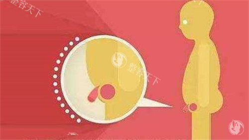 李世荣做一次延长手术多少钱？阴茎延长5w起，延长加增粗8w起