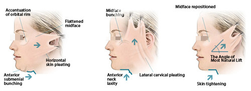 面部提升三种提升方向
