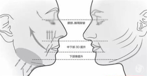 面部提升前后各个部位的对比