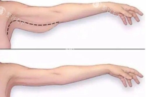 合肥华美吸脂靠谱医生大盘点，赵辑、朱德刚、杨鹏助你实现美丽蜕变！