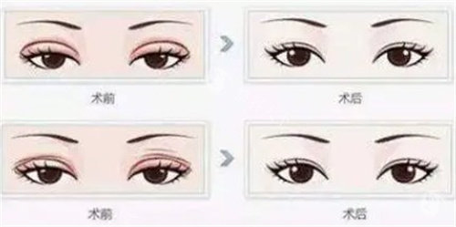 双眼皮修复