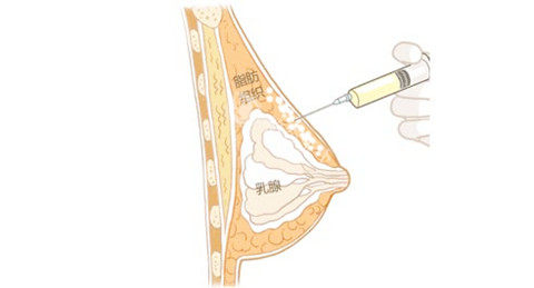 自体脂肪隆胸通图