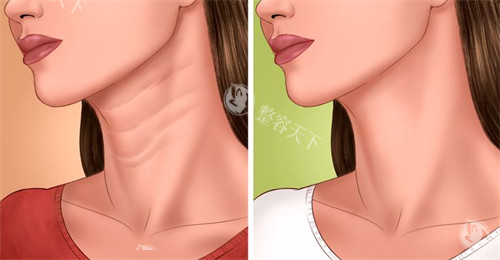 去颈纹前后对比