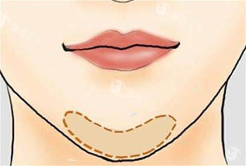玻尿酸丰下巴的位置