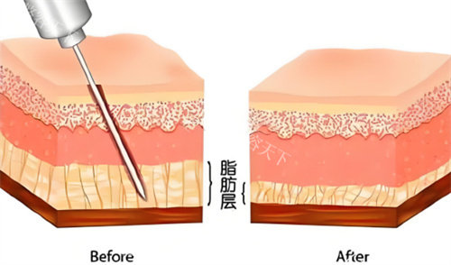 吸脂手术脂肪层对比