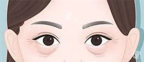 眼袋松弛和泪沟细纹展示图