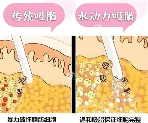 负压吸脂和水动力吸脂方式对比动画图