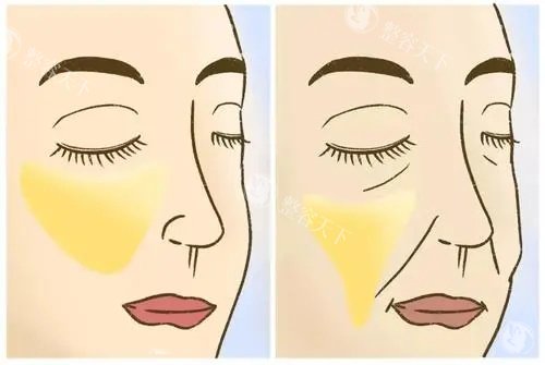 面部脂肪填充示意图