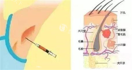 长沙美莱清新微波去腋臭技术怎么样?40分钟无疤体验和5年结果亲测分享