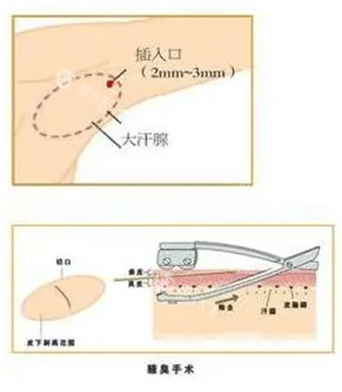 腋臭手术过程图解