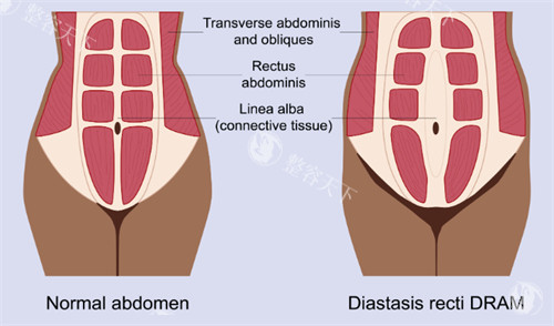 腹壁成形改善腹直肌
