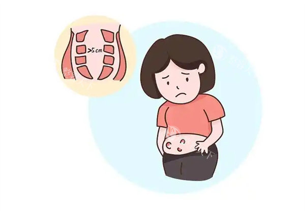 腹直肌分离图片