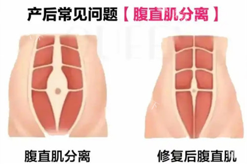 腹直肌修复漫画图