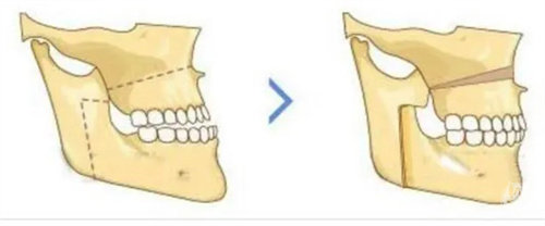 深圳哪里做正颌手术好？多家强院PK，美莱小创口隐蔽切口+艺星更准一些截骨，双颌8万起性价比高