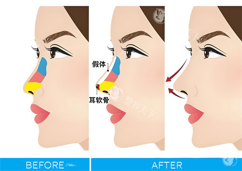 隆鼻手术图解动画图