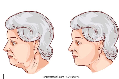 颈部拉皮卡通图