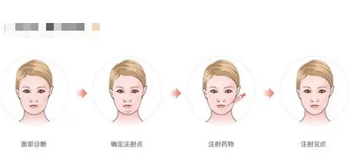 骸肌放松注射过程示意图