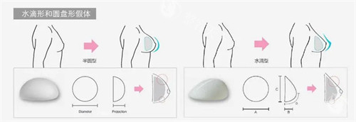 东莞爱思特隆胸怎么样？魏鑫铭|黄刚这两位做胸经验多，费用在12800-69800+