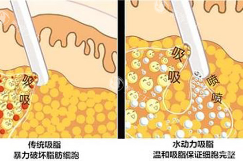 吸脂示意图