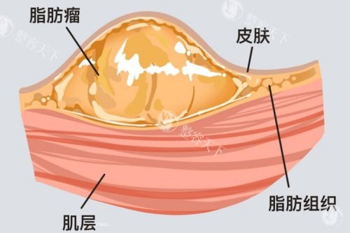 脂肪瘤所在皮肤层面示意图