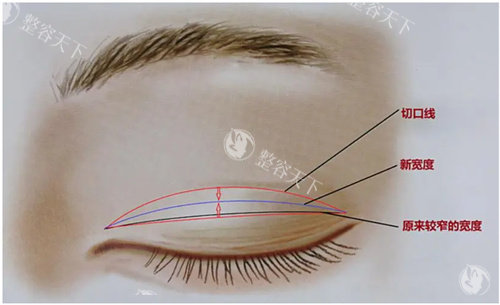 双眼皮肉条修复术原理