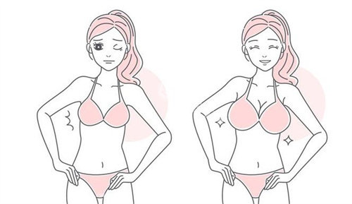 隆胸手术前后
