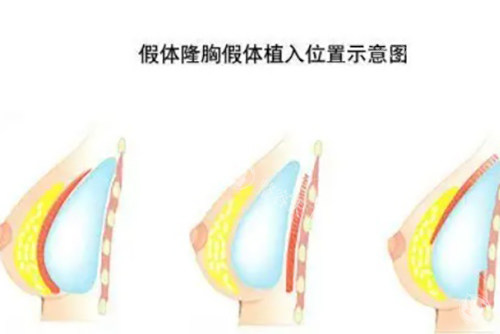 假体隆胸示意图