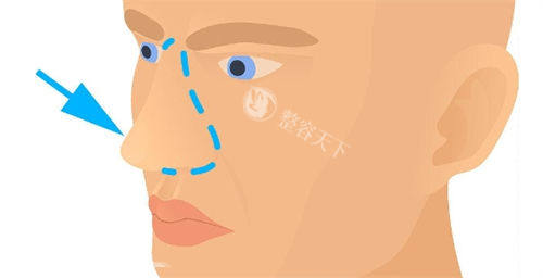 鼻部画线展示图