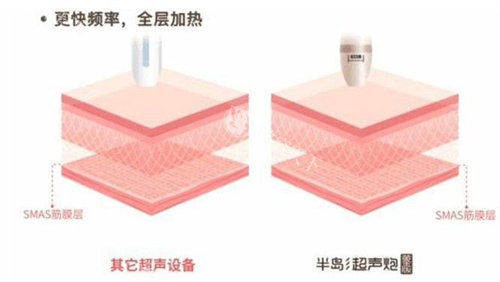 兰州黄金超声炮哪家有？千雨医疗_调Q点阵+植发_西津西路便捷约！