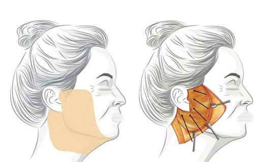 张志国面部年轻化怎么样？兰州韩美坐诊_拉皮收费8680起_口碑赞！