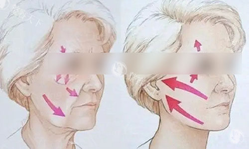 崔昌墉做拉皮手术在沈阳技术好不好？探店实测他的技术和术后改善，一篇讲明白！