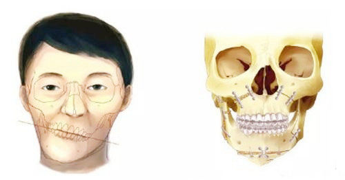 周会喜正颌手术价格明细：地包天/凸嘴/双颌收费5万起，无隐藏费-整容天下