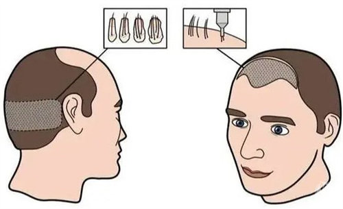 苏州亚植植发中心怎么样，专注植发领域10年+/FUE无痕技术创伤小/毛囊存活率高口碑棒！