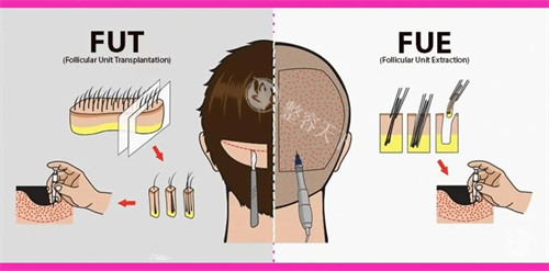 北京植发价格是多少钱？2026北京植发收费明细：10大技术+6大部位价格表，从8000到50000元起！