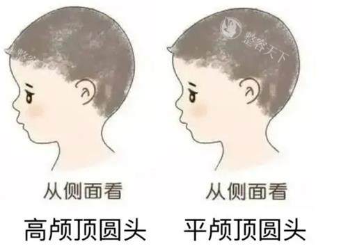 颅顶低必看！骨水泥填充术重塑头包脸，3天改善自然高颅顶