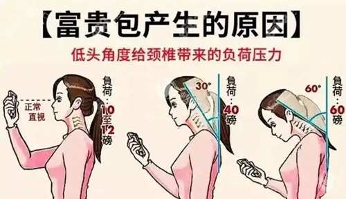 温州徐淑卿医生做富贵包手术好吗？小创伤螺旋刀技术击碎纤维组织，局麻1小时完成，价格透明！